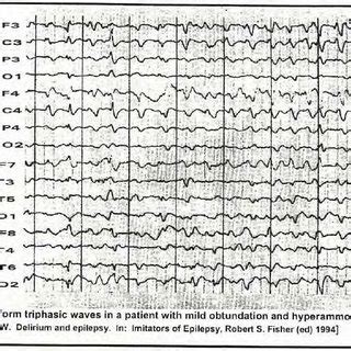 Epileptiform triphasic waves | Download Scientific Diagram