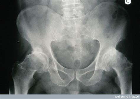 Osteoarthritis - Xray of hips showing narrowing of joint space ...