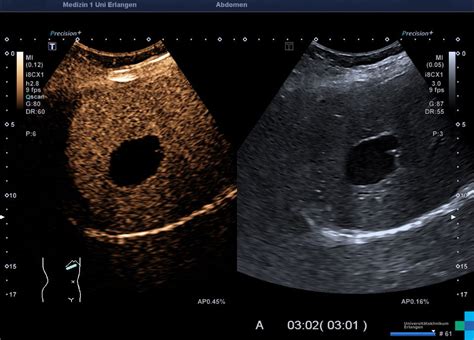 Complex liver cyst (series of images) – Atlas of Ultrasound