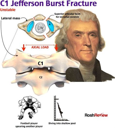 C1 Jefferson Burst Fracture | Emergency medicine, Medical school essentials, Medical knowledge