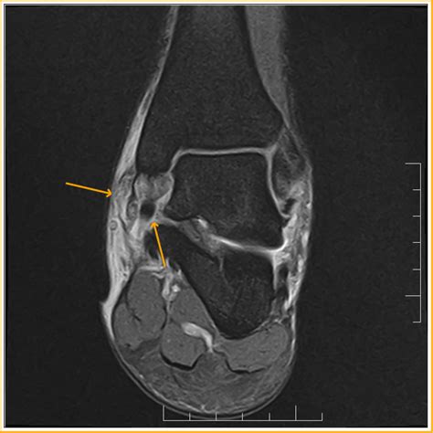 Deltoid Ligament Disruption : MRI - Sumer's Radiology Blog