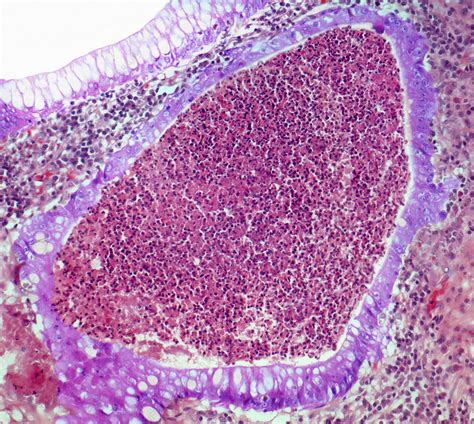 Ulcerative colitis, LM - Stock Image - C058/7861 - Science Photo Library