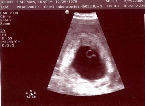 tiny sprouts: 36 week ultrasound