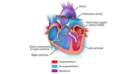 Double Outlet Right Ventricle | Mount Sinai - New York