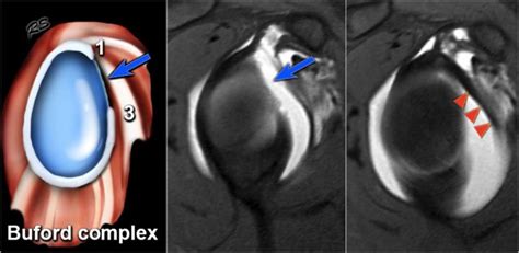 Shoulder Anatomy and Variants on MRI (2022)