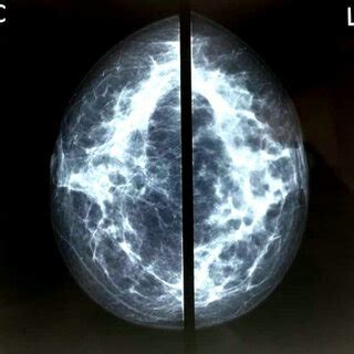 Ultrasonography of breasts indicating mastitis. | Download Scientific Diagram