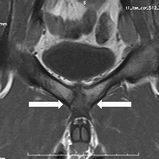 -Signs of bilateral femuro-acetabular CAM impingement (arrows). Figura... | Download Scientific ...