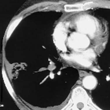 Pulmonary Embolism CT Imaging and Diagnosis: Practice Essentials, Radiography, Computed Tomography