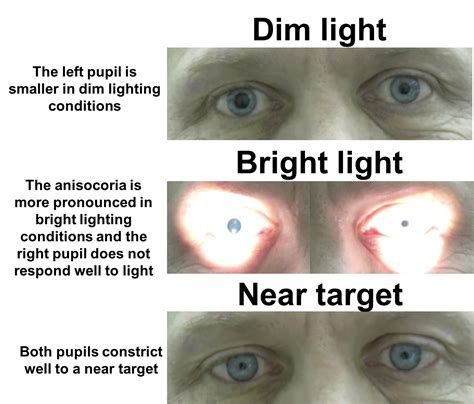 Adie’s tonic pupil – Case-Based Neuro-Ophthalmology