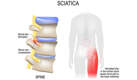 Herniated Disc Treatment