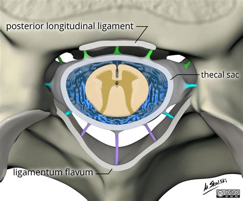 Radiopaedia - Drawing Ligamentum flavum, posterior longitudinal ligament and thecal sac ...