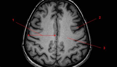 MRI of the White and Gray Matter in the Brain - W-Radiology