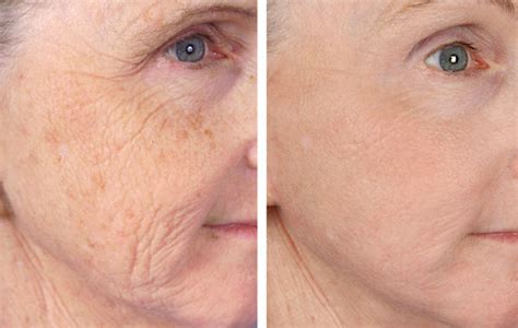 Wrinkle Reduction Denver Centennial DTC | Laser Aesthetics of Colorado