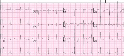 Dr. Smith's ECG Blog: Wellens' waves are NOT equivalent to Wellens' syndrome: Pseudo-Wellens ...