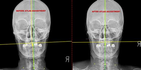 Atlas Adjustment | Menner Chiropractic Sports Medicine