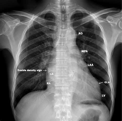 Chest X Ray Heart