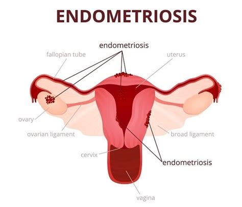 What Helps Endo Belly (Endometriosis and Bloating)?