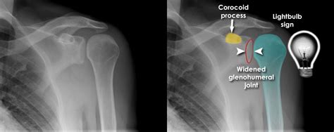 X Ray Normal Shoulder