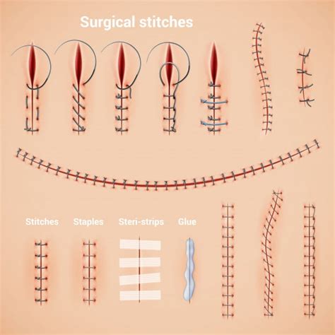 Finger Laceration Repair