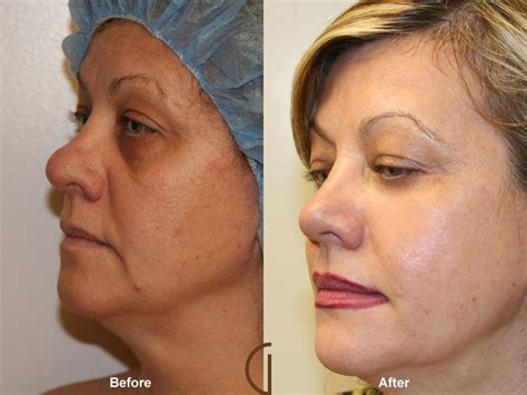 Facial Fat Grafting Newport Beach | Fat Transfer | Dr. Kevin Sadati