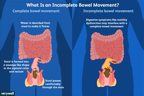 How to Reduce Symptoms of Incomplete Defecation | Sigmoid colon, Bowel ...