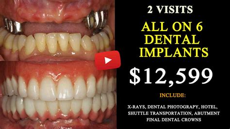 Where to get dental implants and cost of full dental implants - Dental ...