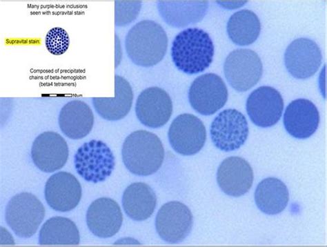 H-hemoglobin disease | Medical Laboratories