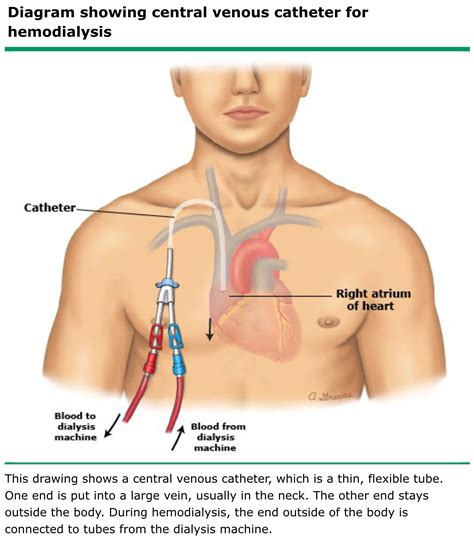 Central Venous Catheter (HD) | Central venous catheter, Patient care technician, Catheter