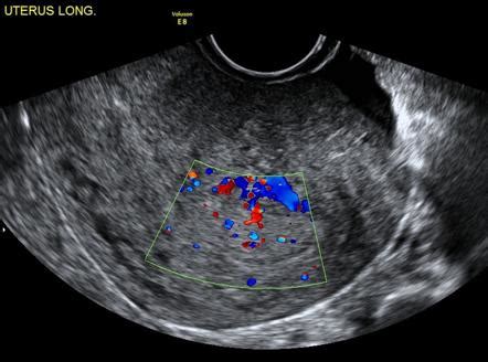 画像 heterogeneous lesion in uterus meaning 253204-What does a heterogeneous uterus mean