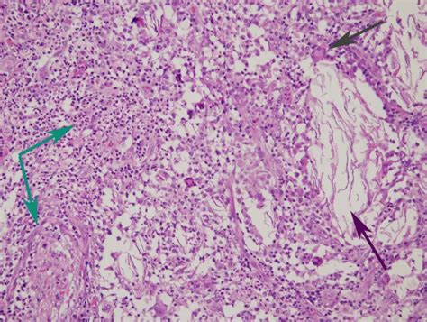 High power view of vernix caseosa peritonitis. This high power view ...