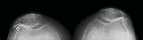 Patellofemoral arthroplasty, a type of partial knee replacement