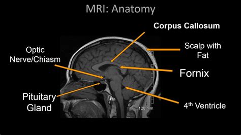 Normal Brain MRI Anatomy - Neuroradiology Made simple - YouTube