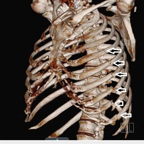 Example of chest wall 3D reconstruction via computer tomography 3D ...