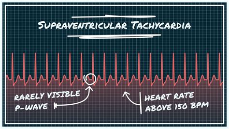 SVT - SUPRAVENTRICULAR TACHYCARDIA - Arrhythmias - Causes, symptoms ...