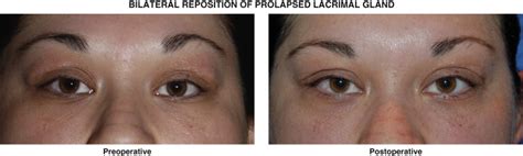 Reposition of prolapsed lacrimal gland | Plastic Surgery Key