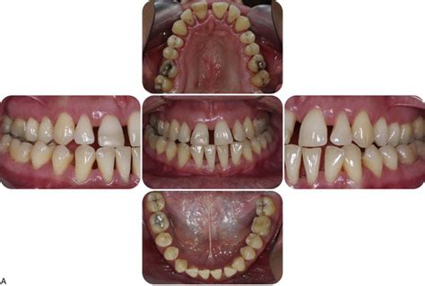 25: Aggressive Periodontitis | Pocket Dentistry