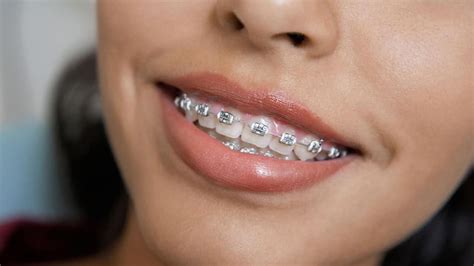 Clear and Metal Braces from a Top Phoenix Orthodontist