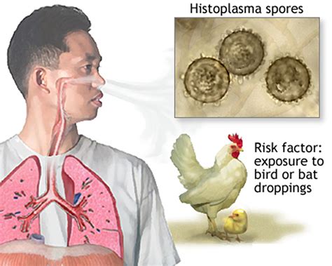 Histoplasmosis - Causes, Symptoms, Diagnosis, Prognosis, Treatment