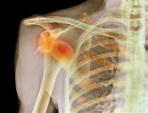 Shoulder Dislocation Symptoms and Treatment