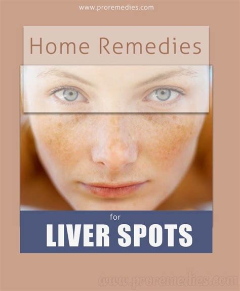 Home Remedies For Liver Spots | Home remedies, Remedies, Health and beauty tips