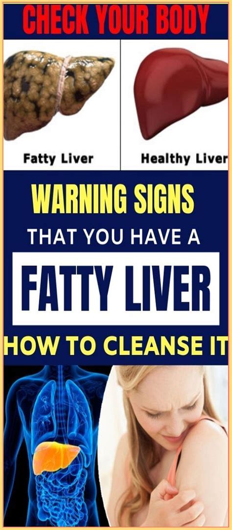 healthhhwww in 2020 | Fatty liver, Liver disease symptoms, Fatty liver disease