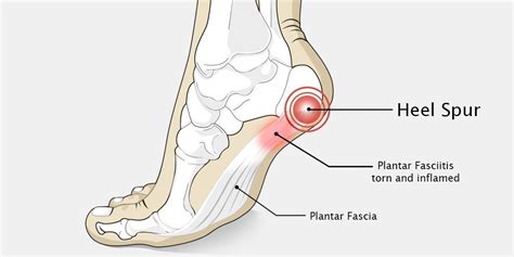 Heel Pain: Causes, Prevention, and Treatments in Houston – Foot Houston