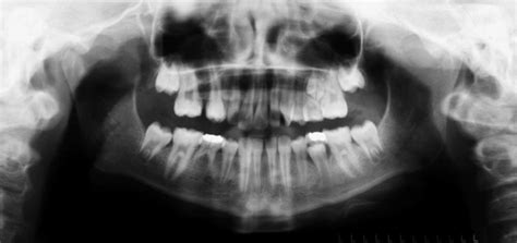 Panoramic radiograph before autotransplantation surgery. | Download Scientific Diagram