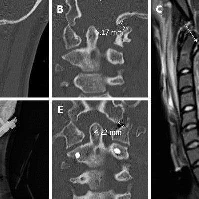 Diagnostic methods for atlanto-occipital dislocation (see text for... | Download Scientific Diagram