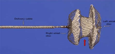 Amplatzer septal occluder (ASO)[6] | Download Scientific Diagram