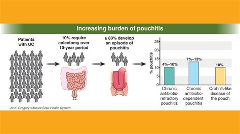 First of its kind comprehensive pouchitis guideline - American ...