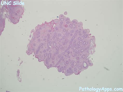 squamous papilloma pathology