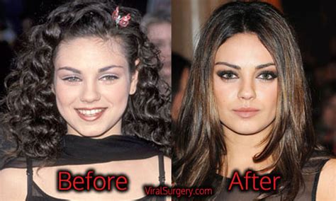 Mila Kunis Plastic Surgery: Before and After Nose, Boob Job Pictures