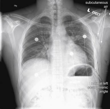 Imaging Chest Trauma | Radiology Key