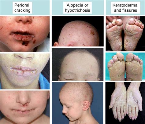 Ectodermal Dysplasia-Skin Fragility Syndrome | Plastic Surgery Key